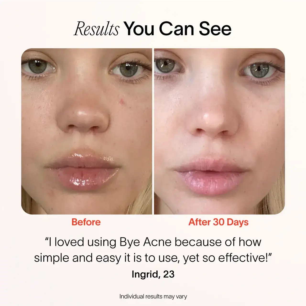 Solawave Bye Acne: 3-Minute Pimple Spot Treatment
