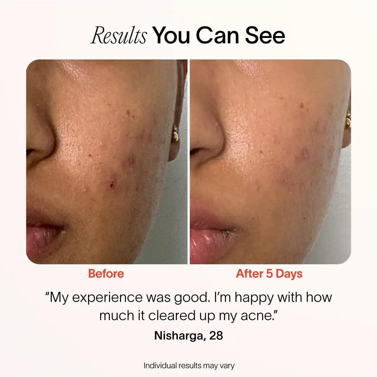 Solawave Bye Acne: 3-Minute Pimple Spot Treatment